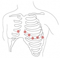 Chest Lead Placement