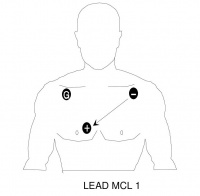 Placement for monitoring Lead MCL I
